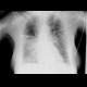 Aspiration pneumonia: X-ray - Plain radiograph