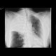 Atelectasis and tumorous infiltration of right upper lobe: X-ray - Plain radiograph