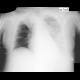 Right upper lobe atelectasis, pleural effusion on supine radiograph: X-ray - Plain radiograph