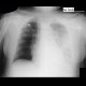 Right upper lobe atelectasis, pleural effusion on supine radiograph: X-ray - Plain radiograph