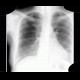 Atherosclerosis, subclavian artery: X-ray - Plain radiograph