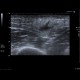 Atheroma, arm: US - Ultrasound