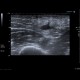 Atheroma, arm: US - Ultrasound