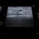 Atheroma, arm: US - Ultrasound