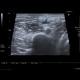 Atheroma, arm: US - Ultrasound