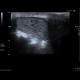 Atheroma in intergluteal cleft: US - Ultrasound