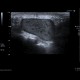 Atheroma in intergluteal cleft: US - Ultrasound