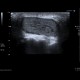 Atheroma in intergluteal cleft: US - Ultrasound