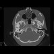 Atresia of external auditory canal: CT - Computed tomography