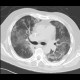 Atypical pneumonia: CT - Computed tomography