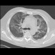 Atypical pneumonia: CT - Computed tomography