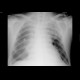 Atypical pneumonia, pleural effusion: X-ray - Plain radiograph