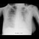 Atypical pneumonia, first case: X-ray - Plain radiograph