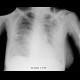 Atypical pneumonia: X-ray - Plain radiograph