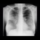 Atypical pneumonia: X-ray - Plain radiograph