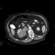 Renal cell carcinoma, atypical: CT - Computed tomography