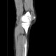 Baker's cyst on CT: CT - Computed tomography