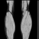 Baker's cyst on CT: CT - Computed tomography