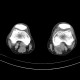 Baker's cyst on CT: CT - Computed tomography