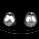 Baker's cyst on CT: CT - Computed tomography