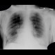 Basal bronchopneumonia: X-ray - Plain radiograph