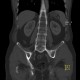 Ankylosing spondylitis, Bechterew's disease, Crohn's disease: CT - Computed tomography