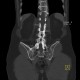 Ankylosing spondylitis, Bechterew's disease, Crohn's disease: CT - Computed tomography