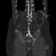 Ankylosing spondylitis, Bechterew's disease, Crohn's disease: CT - Computed tomography