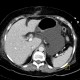 Biloma, complication of biliary drainage, PTC: CT - Computed tomography