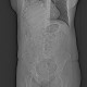 Diaphragmatic hernia, Morgagni hernia: CT - Computed tomography