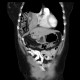 Diaphragmatic hernia, Morgagni hernia: CT - Computed tomography