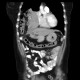 Diaphragmatic hernia, Morgagni hernia: CT - Computed tomography