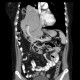 Diaphragmatic hernia, Morgagni hernia: CT - Computed tomography