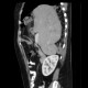 Diaphragmatic hernia, Morgagni hernia: CT - Computed tomography