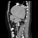 Diaphragmatic hernia, Morgagni hernia: CT - Computed tomography