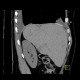 Diaphragmatic hernia, Morgagni hernia: CT - Computed tomography