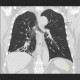Bronchiectasia, HRCT: CT - Computed tomography