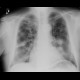 Bronchoinvasive aspergillosis, aspergillosis: X-ray - Plain radiograph