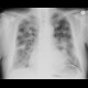 Bronchoinvasive aspergillosis, aspergillosis: X-ray - Plain radiograph