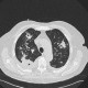 Bronchoinvasive aspergillosis, aspergillosis: CT - Computed tomography