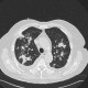 Bronchoinvasive aspergillosis, aspergillosis: CT - Computed tomography