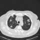 Bronchoinvasive aspergillosis, aspergillosis: CT - Computed tomography