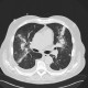 Bronchoinvasive aspergillosis, aspergillosis: CT - Computed tomography