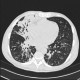 Bronchopneumonia, tree-in-bud: CT - Computed tomography