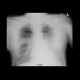 Bronchopneumonia, biopsy: X-ray - Plain radiograph