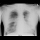 Bronchopneumonia, biopsy: X-ray - Plain radiograph