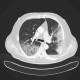 Bronchopneumonia, biopsy: CT - Computed tomography