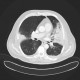 Bronchopneumonia, biopsy: CT - Computed tomography