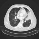 Bronchopneumonia, biopsy: CT - Computed tomography