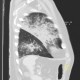 Bronchopneumonia, biopsy: CT - Computed tomography